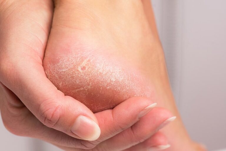 Calluses - Markham Foot Care Clinic | Chiropodist Brian Cragg | foot ...